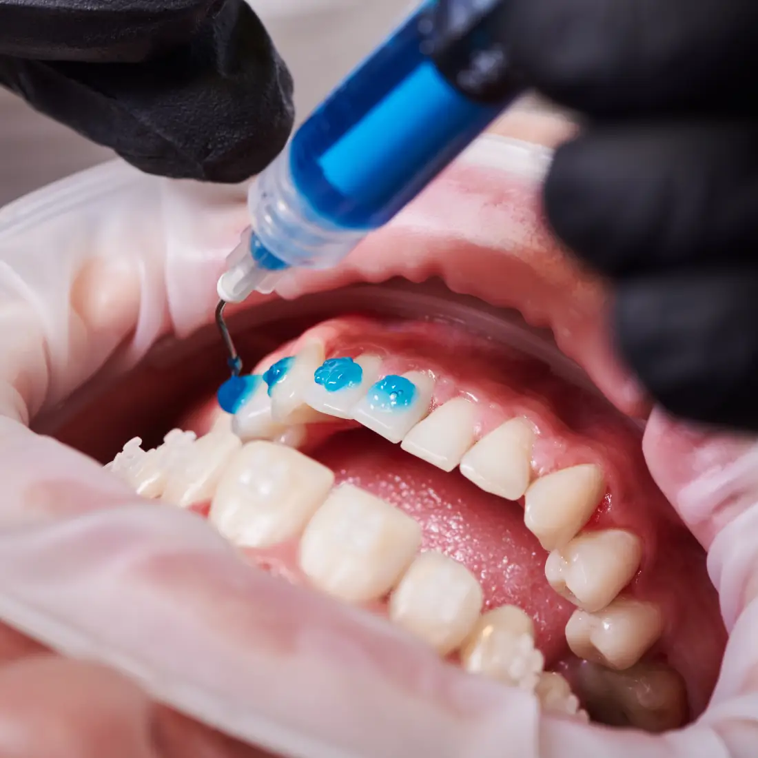 Teeth Whitening