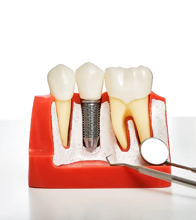 Dental Implant