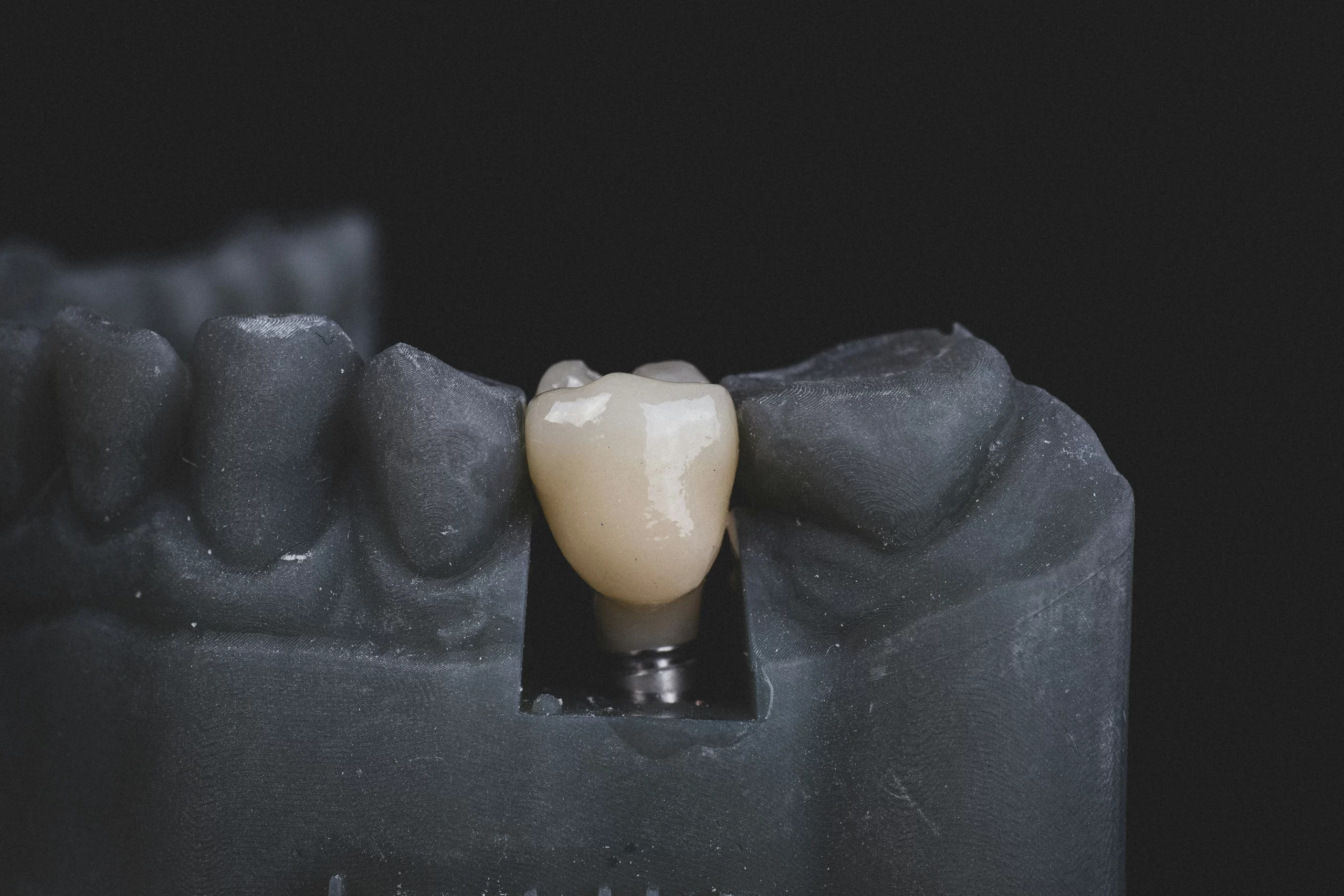 Illustration of dental implants with a focus on titanium post and crown placement.